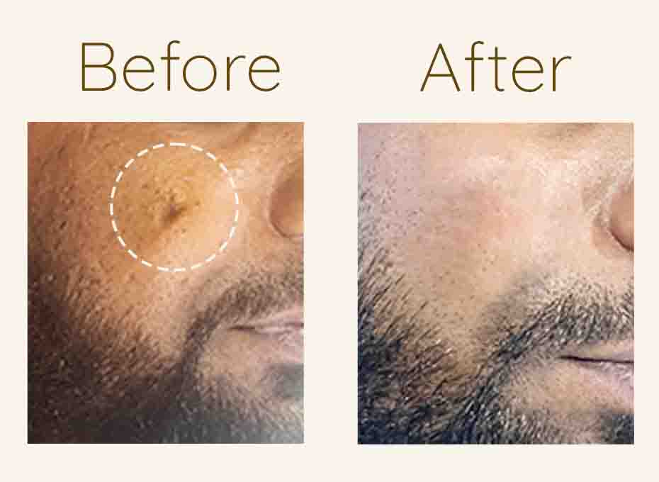 acne Scar treatment