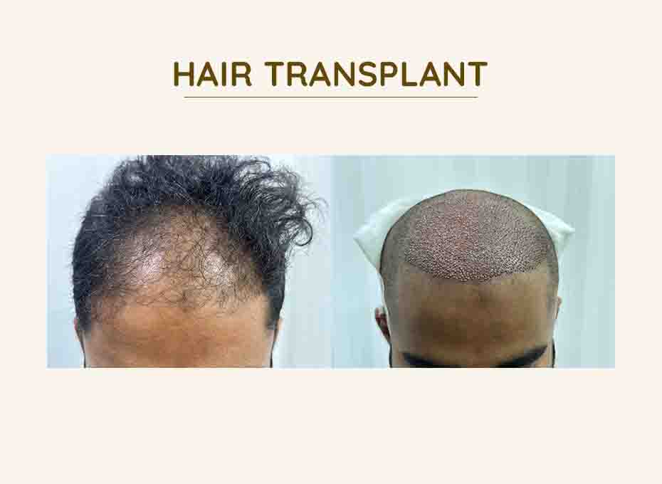 Hair Transplant