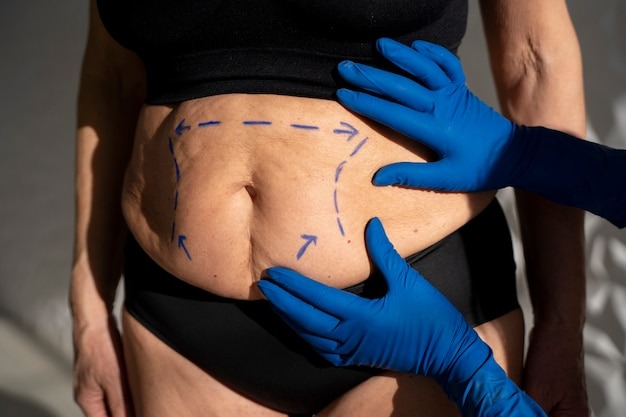 Liposcution Treatment