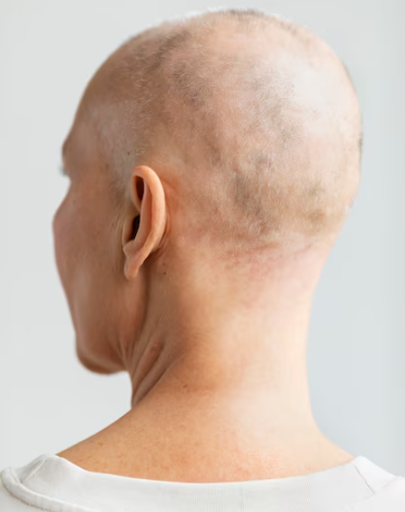 Hair Transplant