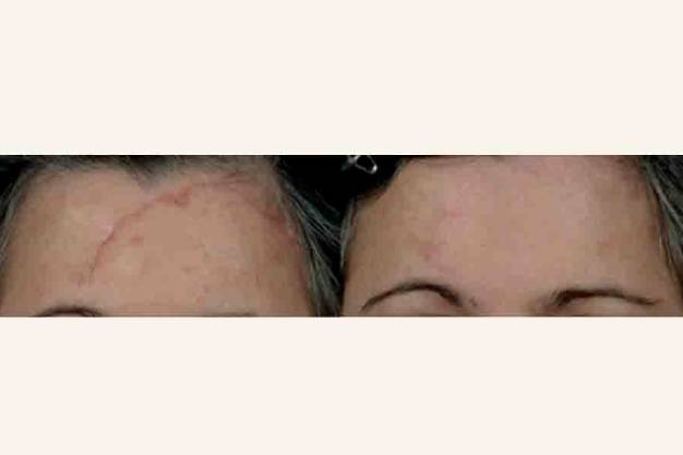 scar