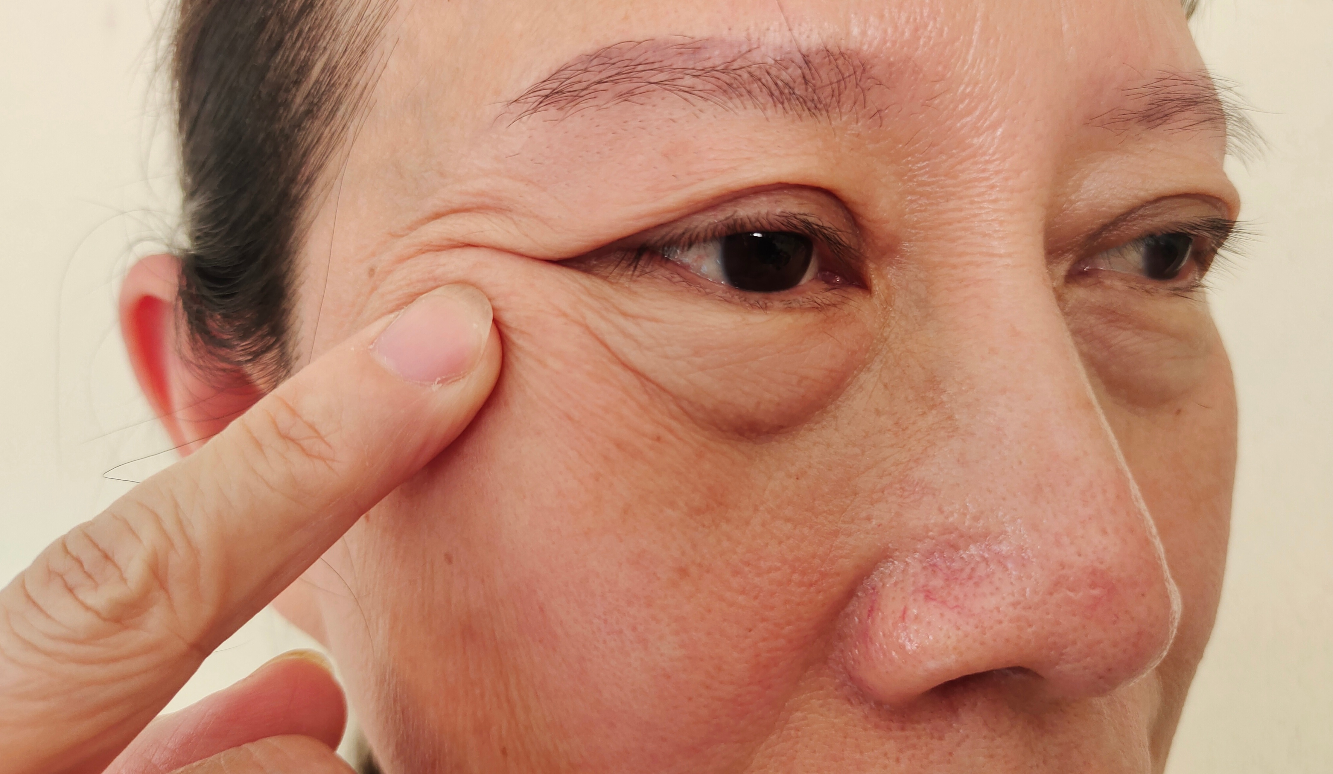 Under-Eye Bags Treatment